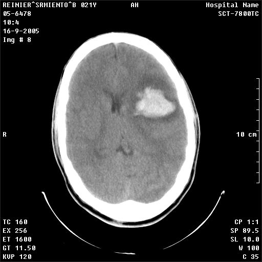 Accidente vasculare cerebrale la varstnici